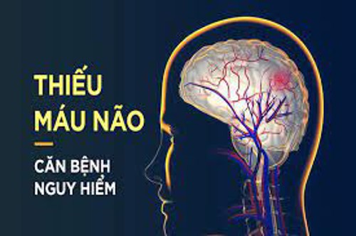 Nhận thức đúng về thiếu máu não thời hiện đại